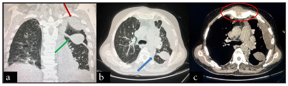 CT chest images showing (a) loculated pleural effusion (green arrow) with fissural effusion (red arrow), (b) with collapse consolidation of underlying lung on the left side (blue arrow). (c) Multiple lytic lesions can be seen in the visualized bones and soft tissue component of the plasmacytoma on the sternum and left first rib (red circle).