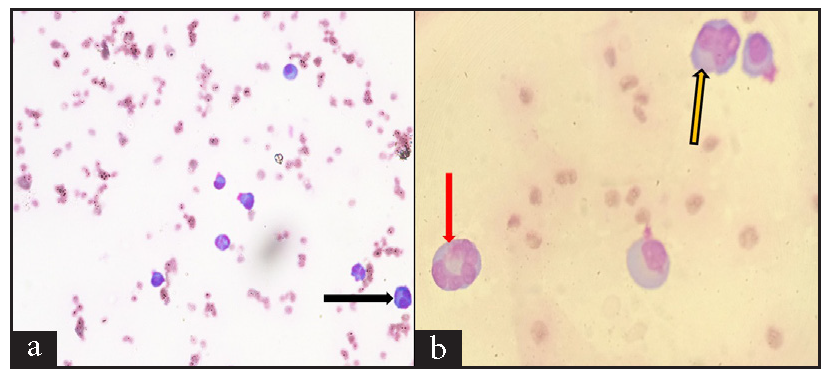 Wright-Geimsa stained smears show mature and immature plasma cells, including (a) 400X, Bilobed plasma cell (black arrow), and (b) 1000X, multilobed plasma cells (red and yellow arrows).