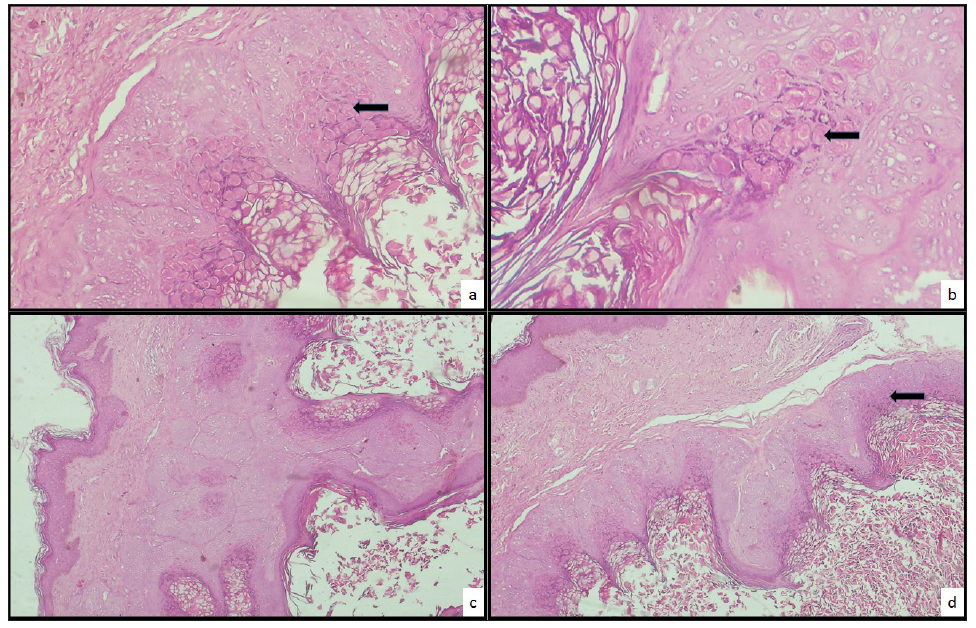 (a) Photomicrograph showing skin-lined tissue with numerous intracytoplasmic eosinophilic inclusions or molluscum bodies (black arrow) within the squamous cells (H & E; × 200). (b) Higher magnification showing molluscum bodies (black arrow) (H & E; ×400). (c & d) Photomicrograph showing skin-lined tissue with the presence of a cyst lined by stratified squamous epithelium showing intracytoplasmic molluscum bodies (black arrow) (H & E; ×200). H&E: hematoxylin and eosin stain.