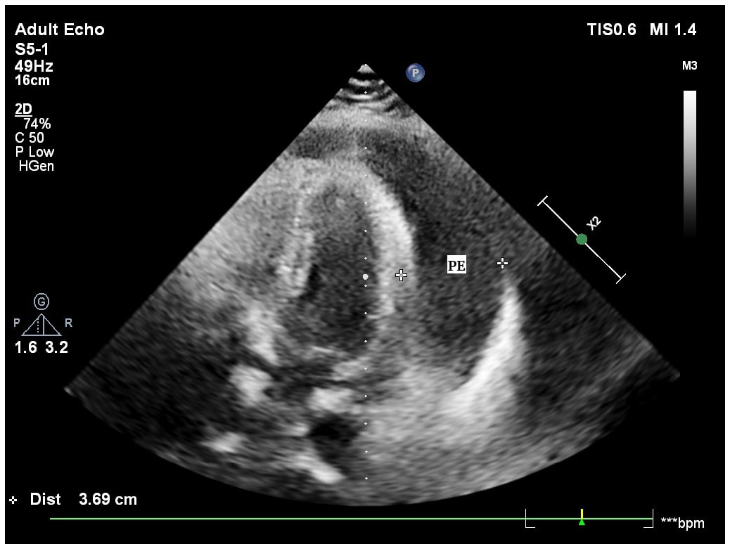 Echocardiogram of a patient diagnosed to have tuberculous pericardial effusion (PE).