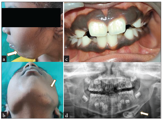 (a and b) White arrow showing Diffuse extraoral swelling in the left lower border of mandible with surgical scar, (c) Intraoral view showing no abnormalities, and (d) White arrow in orthopantomogram showing extraosseous bony growth with enclosed tooth buds.