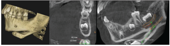 Cone beam computed tomography (CBCT) showing accessory neurovascular bundle.