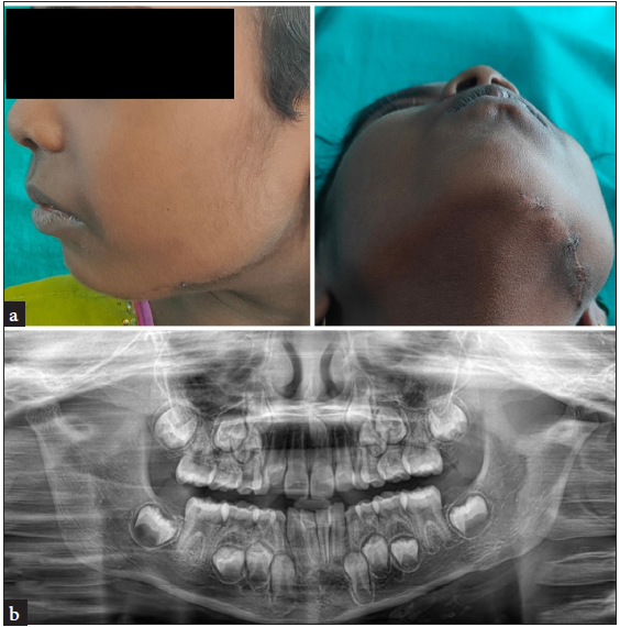 (a) Postoperative images; (b) Postoperative orthopantomogram.