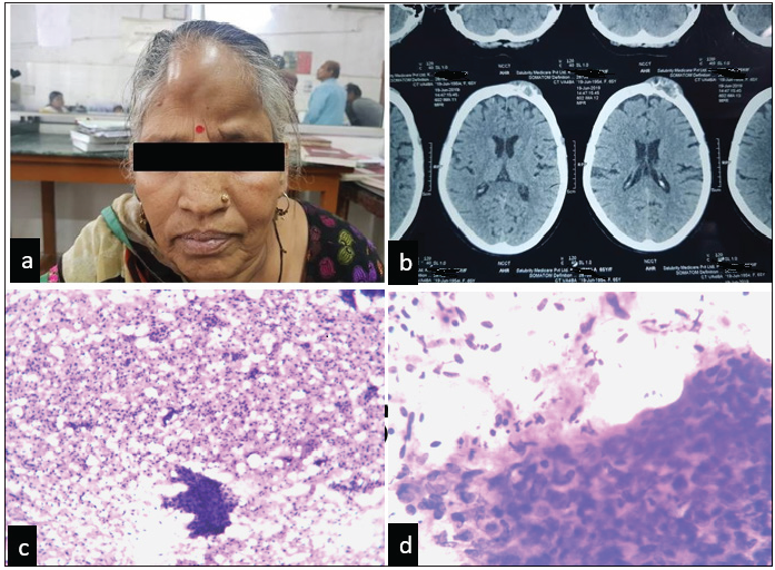 (a) Patient presenting with frontal swelling. (b) NCCT showing well-defined, heterodense osteodestructive soft tissue lesion involving the frontal bone on the left side with destruction of the outer table of the skull and involvement of the overlying scalp. (c, d) FNAC findings of scalp swelling. H & E stained smears showings clusters of malignant squamous epithelial cells. (c) (4x), (d) (10x). NCCT:Contrast enhanced computed tomography, FNAC: Fine needle aspiration cytology, H&E: Hematoxylin and eosin stain.
