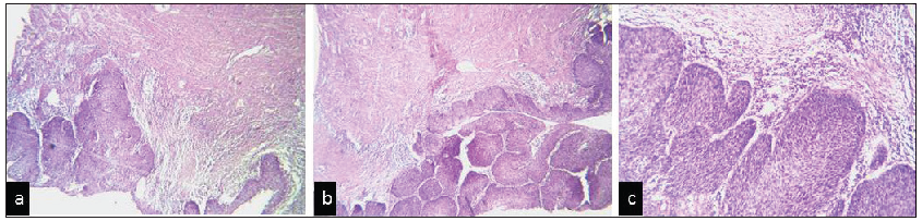 (a, b) [H&E] Sections from endometrium showing micro-invasive squamous cell carcinoma. (4x,4x), (c) [H&E] Sections from cervix showing dysplasia (10x), H&E: Hematoxylin and eosin stain