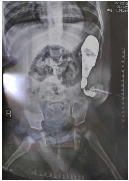 Proximal colostogram done in a patient with a complaint of constipation after colostomy was made. A transition zone is visible in the proximal colon.