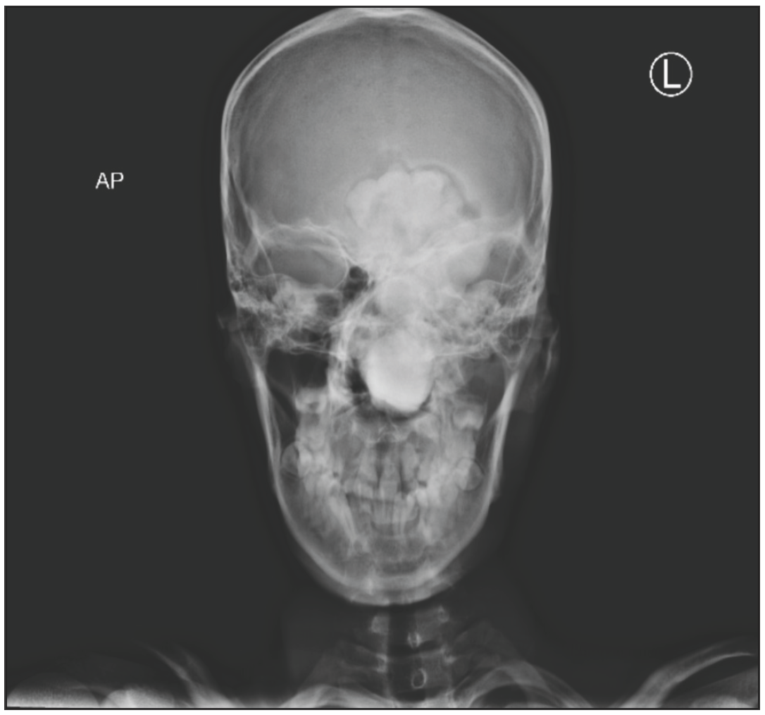 X-ray face and paranasal sinus; AP view shows a calcified expansile mass, occupying the left nasal cavity, left maxillary sinus, left ethmoid sinus, and the left frontal sinus. AP: Anteroposterior view.