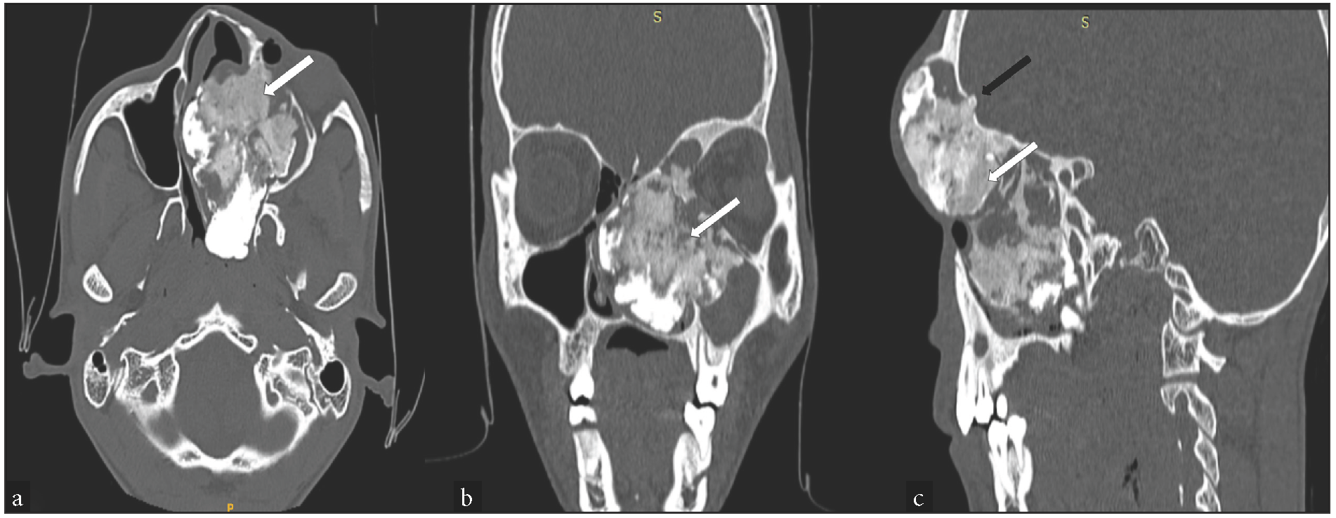 (a) Axial CT scan shows that the mass (white arrow) contains densely ossified, ground glass and noncalcified components. (b) Coronal CT shows the extent of the mass. Note that the medial wall of left orbit is deviated but no orbital wall erosion is present. (c) Sagittal section shows focal erosion in the posterior wall of the left frontal sinus (black arrow). (b,c): White arrow signifies the mass. CT: Computed tomography.