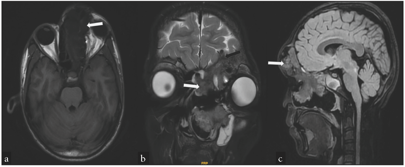 (a) T1 weighted axial MRI shows a hypointense sinonasal mass (white arrow). (b) Coronal T2 FS image shows mixed signals. Some portions appear T2 hypointense, some are intermediate, while few areas are T2 hyperintense. The orbit is not involved (white arrow). (c) Sagittal FLAIR FS image shows the entire extent of the mass (white arrow). FLAIR FS: Fluid-attenuated inversion recovery, FS: Fat suppression