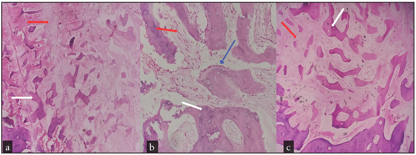 Histopathology slides of the biopsy specimen. (a) There is proliferation of fibrous tissue containing trabeculae of woven bone, (H&E stain 100x magnification). (b) Multiple anastomotic strands of bony trabeculae are seen and osteoblastic rimming is present, (H&E stain 400x magnification). (c) Variable sizes of woven and lamellar bone with fibrous tissue. Red arrows denote fibrous tissue, white arrows denote mature bony trabeculae, and blue arrows show osteoblastic rimming, (H&E stain 200x magnification). H&E: Hematoxylin and eosin stain.